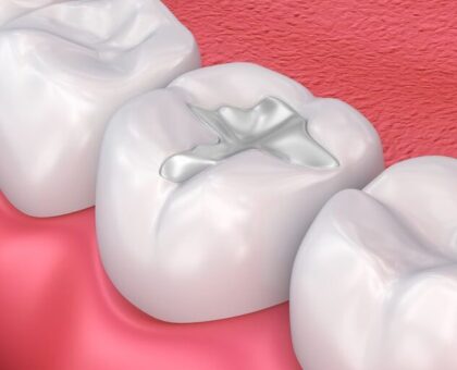 Dental Fillings
