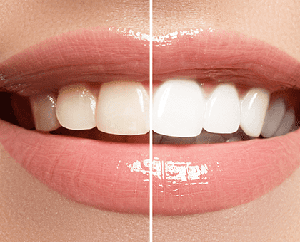 Teeth Whitening